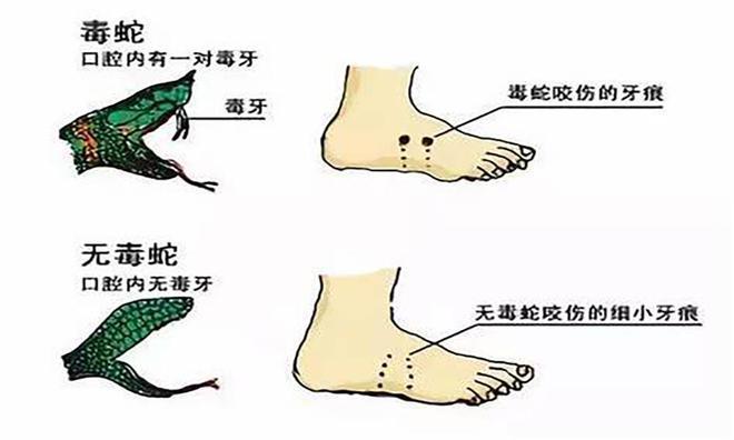 毒蛇咬伤后的自救指南